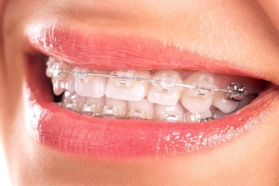 Niềng răng mắc cài sứ