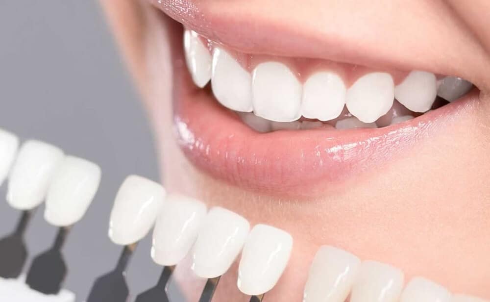 Dán sứ thẩm mỹ