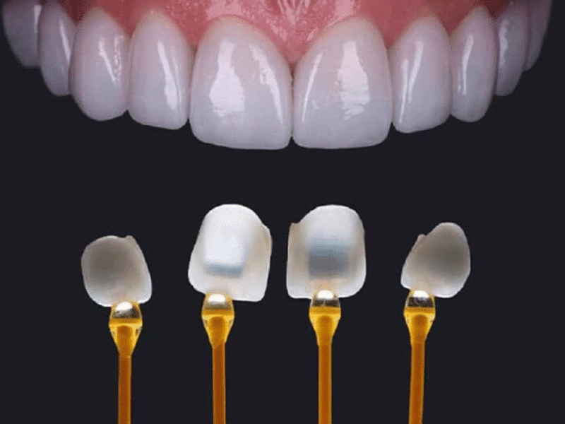 Dán sứ veneer