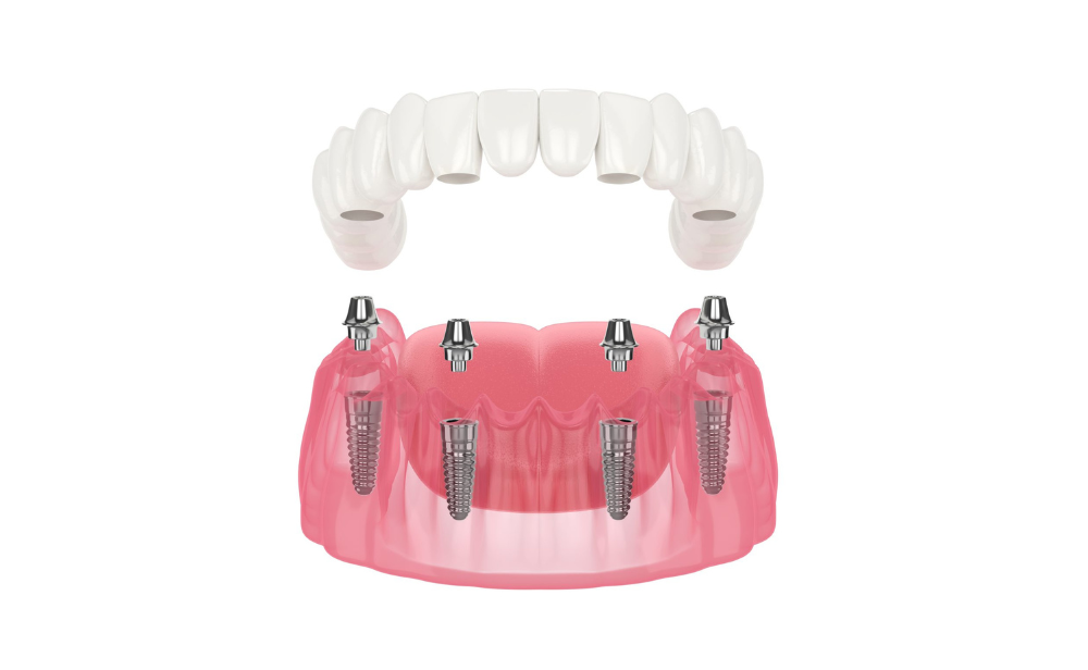 Implant toàn hàm