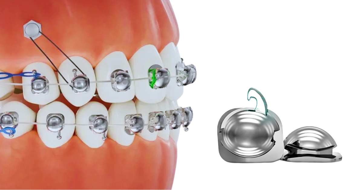 Niềng răng mắc cài cánh cam